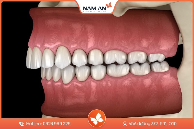 Phẫu Thuật Chỉnh Hàm Hô Khắc Phục Triệt Để Tại Nam An (4)