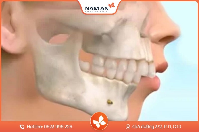 Phẫu Thuật Chỉnh Hàm Hô Khắc Phục Triệt Để Tại Nam An (7)