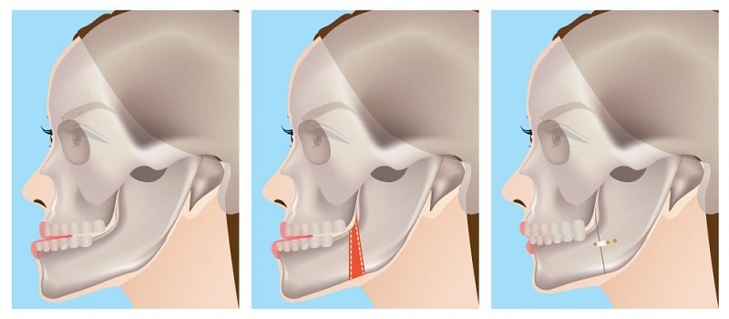 Phẫu Thuật Chỉnh Hàm Móm Do Xương Tại BVTM Nam An (6)