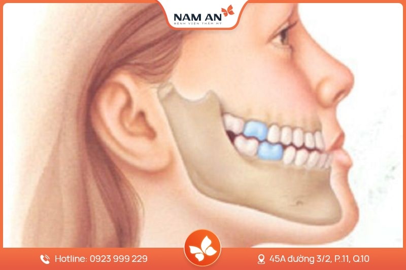 Phẫu Thuật Chỉnh Hàm Móm Do Xương Tại BVTM Nam An (6)