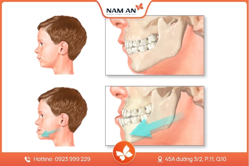 Phẫu Thuật Chỉnh Hàm Móm Do Xương Tại BVTM Nam An (6)
