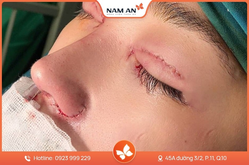 Phẫu Thuật Cuộn Cánh Mũi Thon Gọn Tại BVTM Nam An (2)