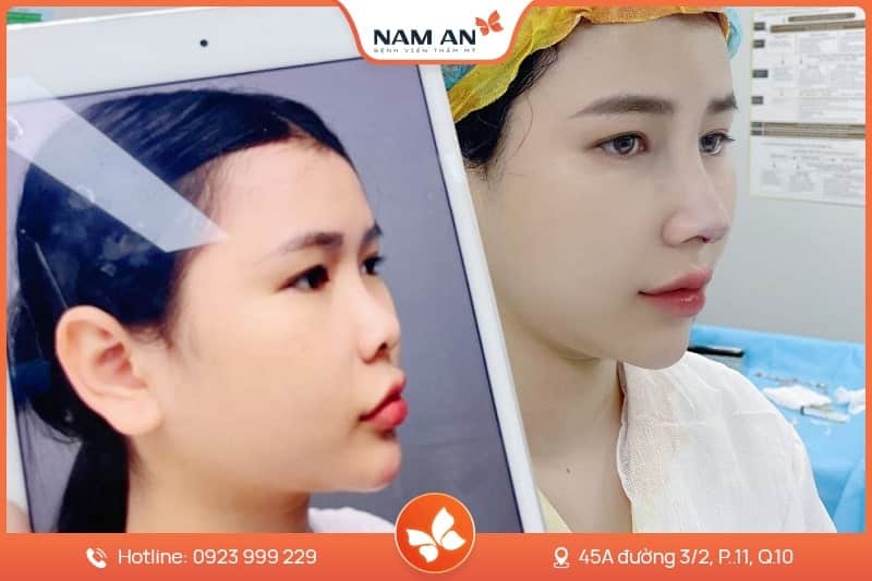 Phẫu Thuật Cuộn Cánh Mũi Thon Gọn Tại BVTM Nam An (2)