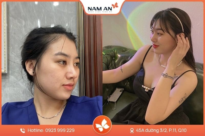 Phẫu Thuật Cuộn Cánh Mũi Thon Gọn Tại BVTM Nam An (5)
