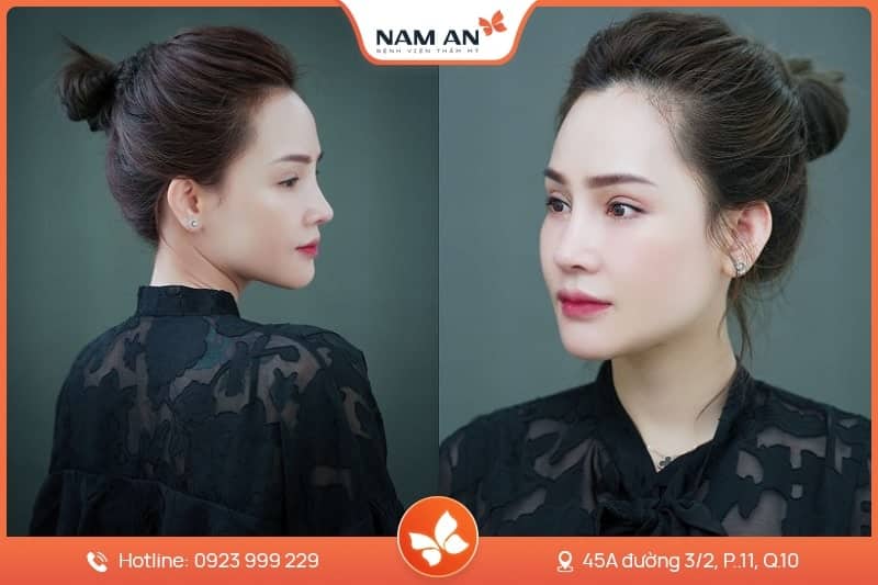 Phẫu Thuật Cuộn Cánh Mũi Thon Gọn Tại BVTM Nam An (7)