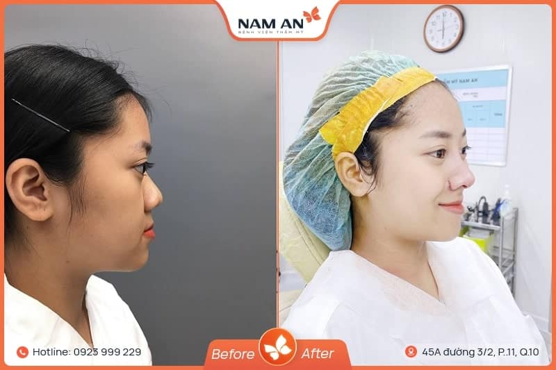 Phẫu Thuật Cuộn Cánh Mũi Thon Gọn Tại BVTM Nam An (8)