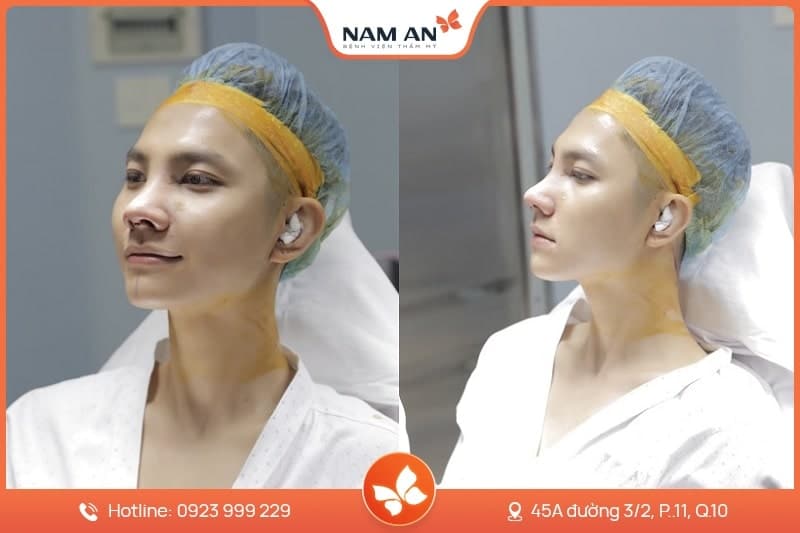 Phẫu Thuật Cuộn Cánh Mũi Thon Gọn Tại BVTM Nam An (9)