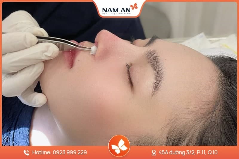 Phẫu Thuật Cuộn Cánh Mũi Thon Gọn Tại BVTM Nam An