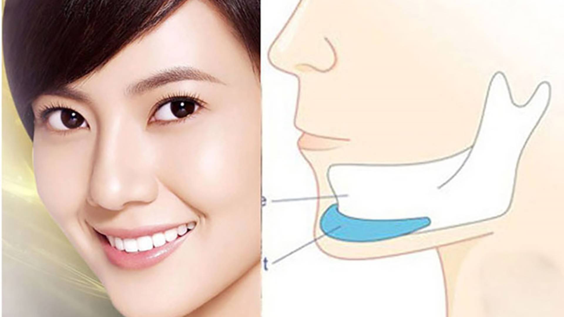 Phẫu Thuật Độn Cằm Duy Trì Được Bao Lâu Giải Đáp (2)