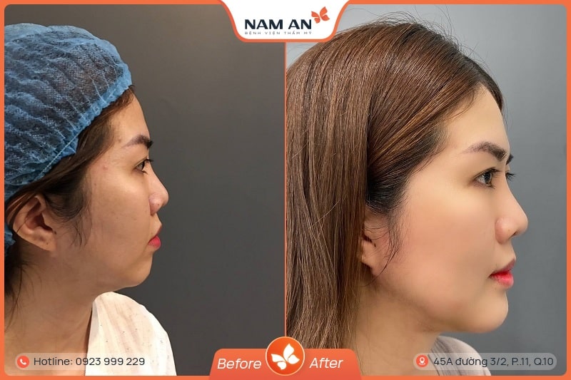 Phẫu Thuật ĐộPhẫu Thuật Độn Cằm V-Line Cân Đối Tại BVTM Nam An (6)n Cằm V-Line Cân Đối Tại BVTM Nam An (6)
