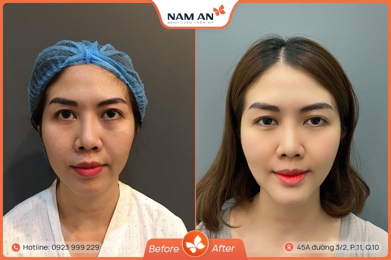 Phẫu Thuật ĐộPhẫu Thuật Độn Cằm V-Line Cân Đối Tại BVTM Nam An (6)n Cằm V-Line Cân Đối Tại BVTM Nam An (6)