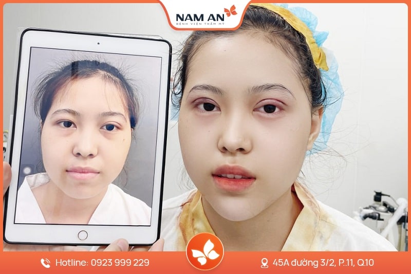 Phẫu Thuật ĐộPhẫu Thuật Độn Cằm V-Line Cân Đối Tại BVTM Nam An (6)n Cằm V-Line Cân Đối Tại BVTM Nam An (6)