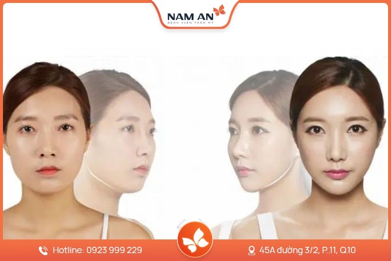 Phẫu Thuật Độn Cằm V-Line Cân Đối Tại BVTM Nam An (4)