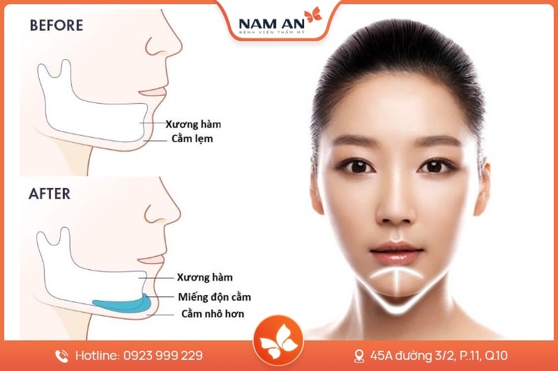 Phẫu Thuật ĐộPhẫu Thuật Độn Cằm V-Line Cân Đối Tại BVTM Nam An (6)n Cằm V-Line Cân Đối Tại BVTM Nam An (6)