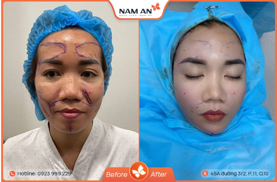 Phẫu Thuật Độn Thái Dương Có Nguy Hiểm Không (3)
