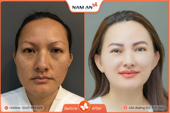 Phẫu Thuật Độn Thái Dương Có Nguy Hiểm Không (6)