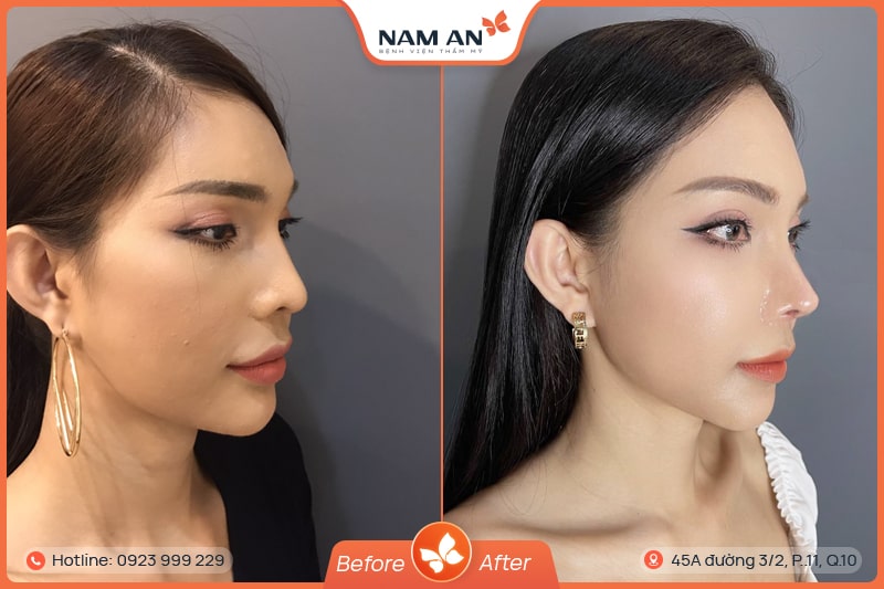 Phẫu Thuật Hạ Gò Má Cao Thanh Tú Tại BVTM Nam An (8)