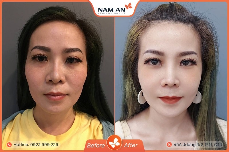 Phẫu Thuật Hạ Gò Má Cao Thanh Tú Tại BVTM Nam An (6)