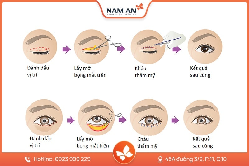 Phẫu Thuật Lấy Mỡ Mi Mắt Trẻ Hóa Đôi Mắt Tại Nam An (1)