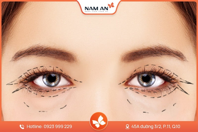 Phẫu Thuật Lấy Mỡ Mi Mắt Trẻ Hóa Đôi Mắt Tại Nam An (3)
