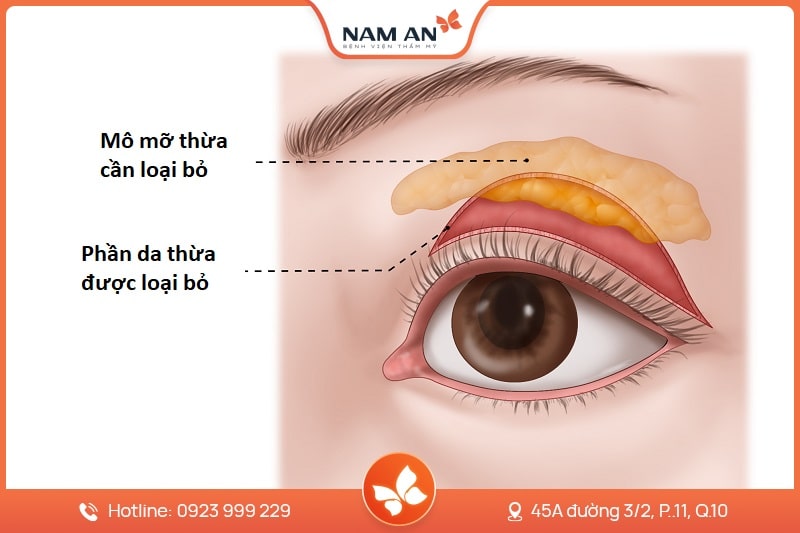 Phẫu Thuật Lấy Mỡ Mi Mắt Trẻ Hóa Đôi Mắt Tại Nam An (5)