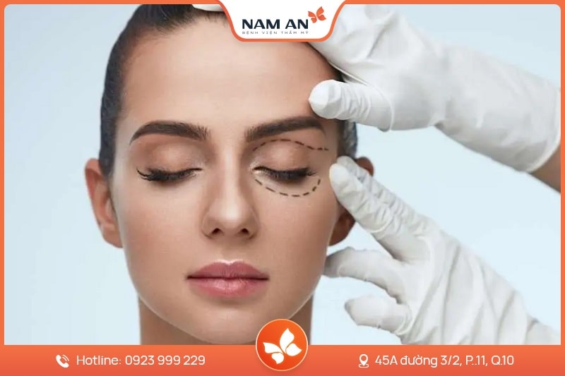 Phẫu Thuật Lấy Mỡ Mi Mắt Trẻ Hóa Đôi Mắt Tại Nam An (9)