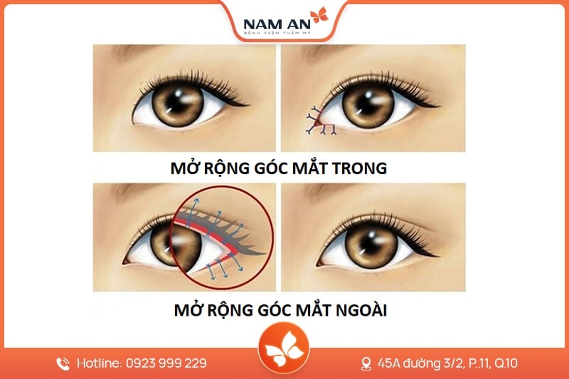 Phẫu Thuật Mở Góc Mắt Trong Và Ngoài Tại BVTM Nam An (1)