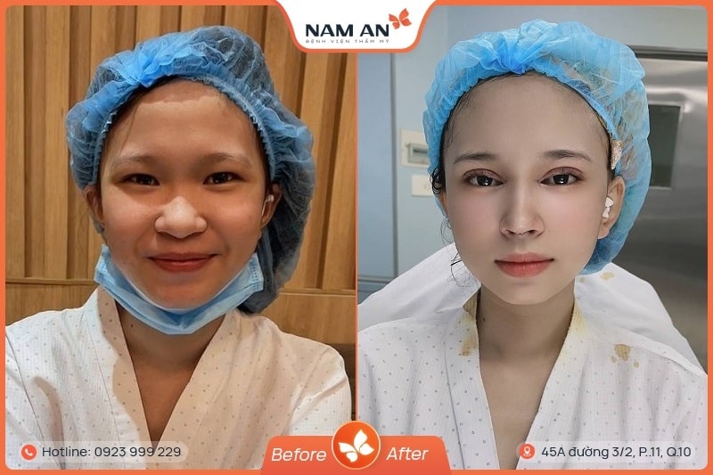 Phẫu Thuật Mở Góc Mắt Trong Và Ngoài Tại BVTM Nam An (2)