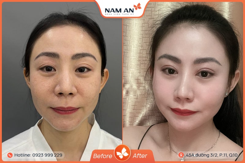 Phẫu Thuật Mở Góc Mắt Trong Và Ngoài Tại BVTM Nam An (3)