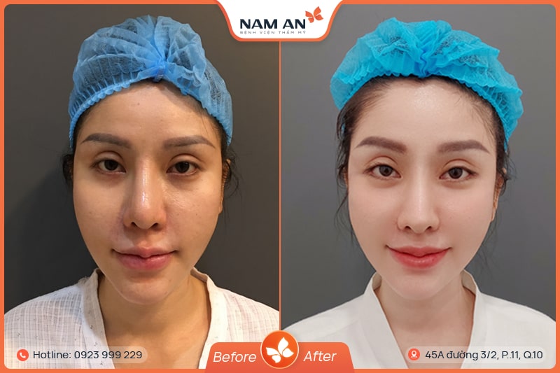 Phẫu Thuật Mở Góc Mắt Trong Và Ngoài Tại BVTM Nam An (5)