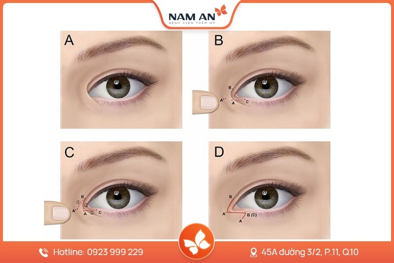 Phẫu Thuật Mở Góc Mắt Trong Và Ngoài Tại BVTM Nam An (7)