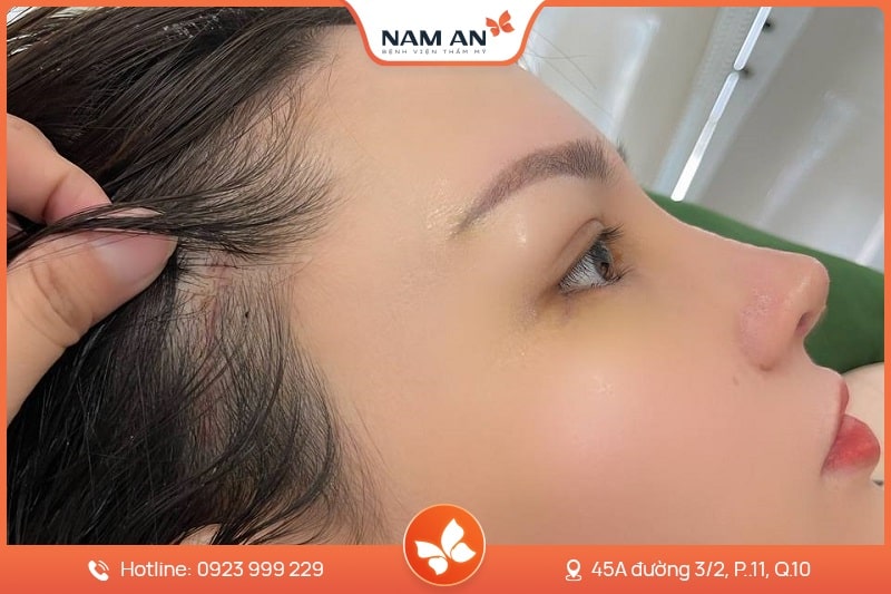 Phẫu Thuật Nâng Cung Chân Mày Trẻ Hóa Mắt Tại Nam An (3)