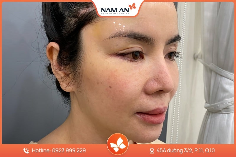 Phẫu Thuật Nâng Cung Chân Mày Trẻ Hóa Mắt Tại Nam An (3)