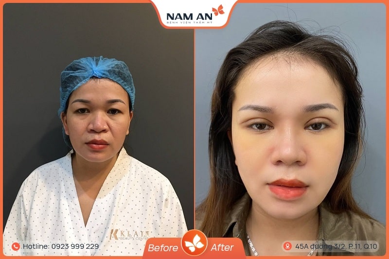 Phẫu Thuật Nâng Cung Chân Mày Trẻ Hóa Mắt Tại Nam An (3)