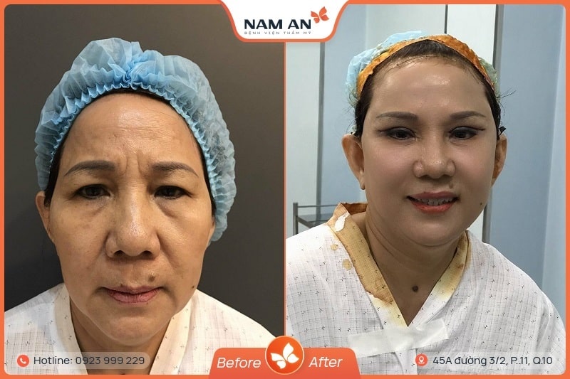 Phẫu Thuật Nâng Cung Chân Mày Trẻ Hóa Mắt Tại Nam An (3)