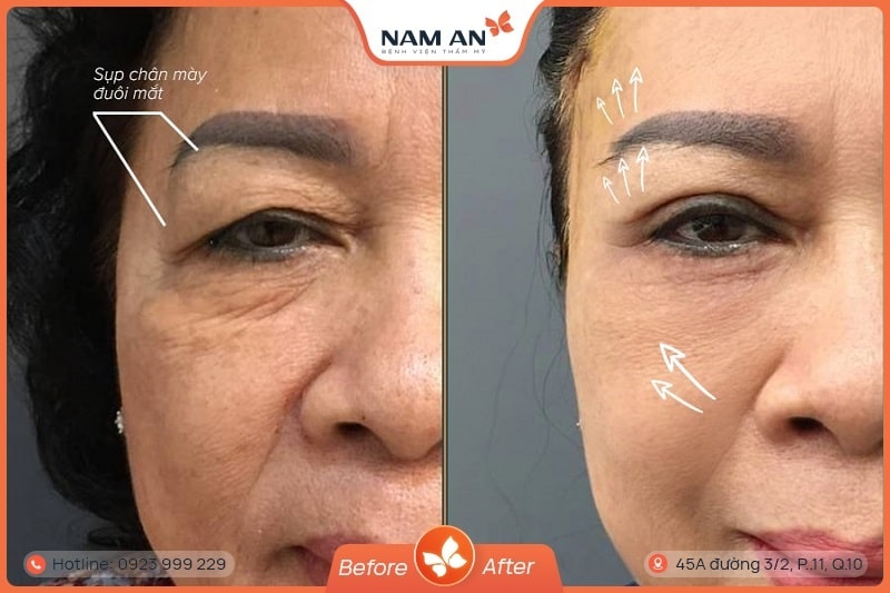 Phẫu Thuật Nâng Cung Chân Mày Trẻ Hóa Mắt Tại Nam An (3)
