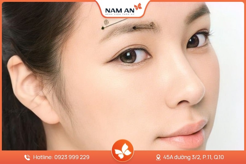 Phẫu Thuật Nâng Cung Chân Mày Trẻ Hóa Mắt Tại Nam An (3)
