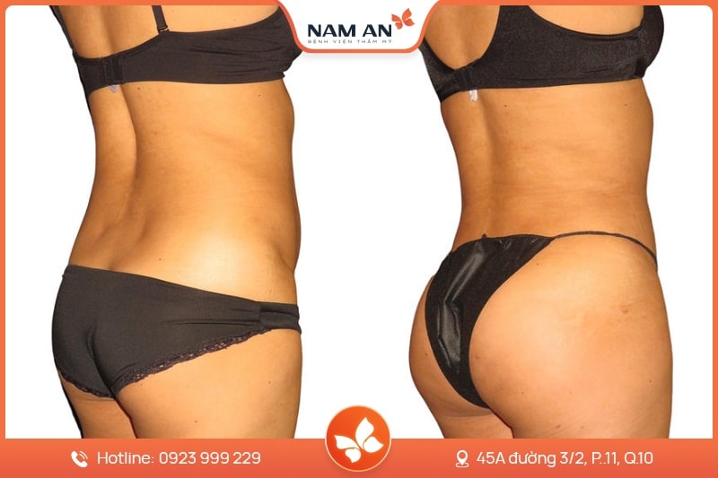 Phẫu Thuật Nâng Mông Nội Soi An Toàn Tại BVTM Nam An (1)