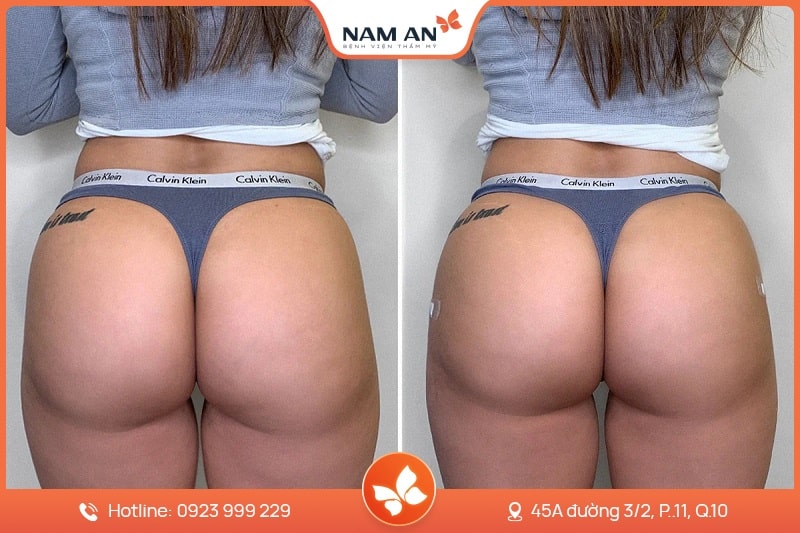 Phẫu Thuật Nâng Mông Nội Soi An Toàn Tại BVTM Nam An (1)