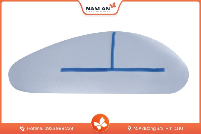 Phẫu Thuật Nâng Mông Nội Soi An Toàn Tại BVTM Nam An (7)
