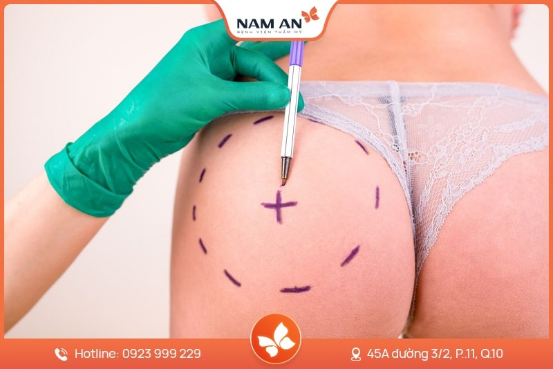 Phẫu Thuật Nâng Mông Nội Soi An Toàn Tại BVTM Nam An (9)