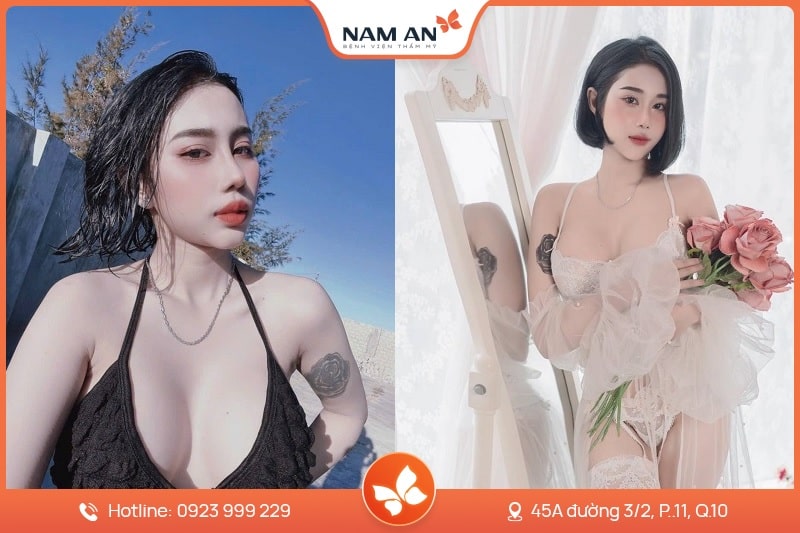 Phẫu Thuật Nâng Ngực Nội Soi An Toàn Tại BVTM Nam An (14)