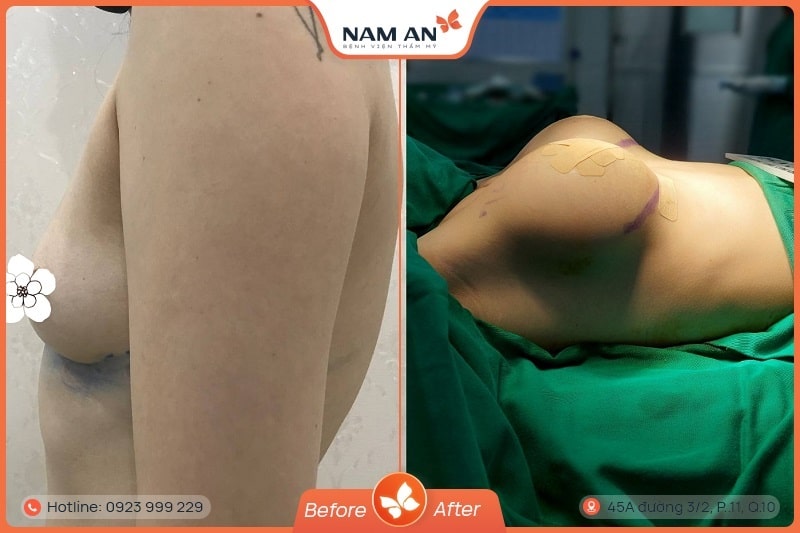 Phẫu Thuật Nâng Ngực Nội Soi An Toàn Tại BVTM Nam An (15)