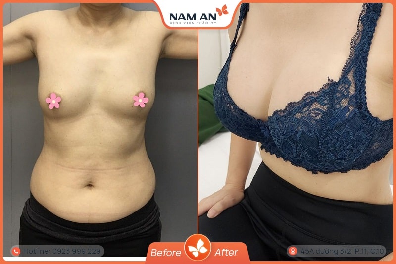 Phẫu Thuật Nâng Ngực Nội Soi An Toàn Tại BVTM Nam An (16)