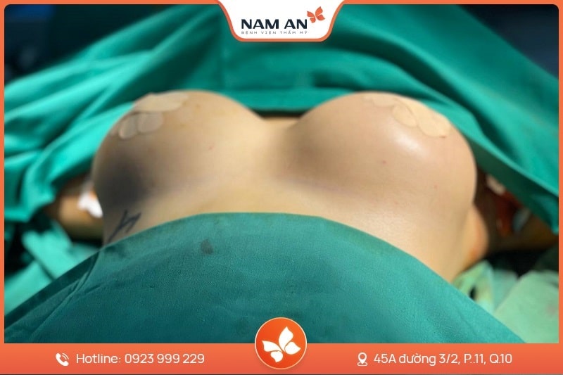 Phẫu Thuật Nâng Ngực Nội Soi An Toàn Tại BVTM Nam An (2)