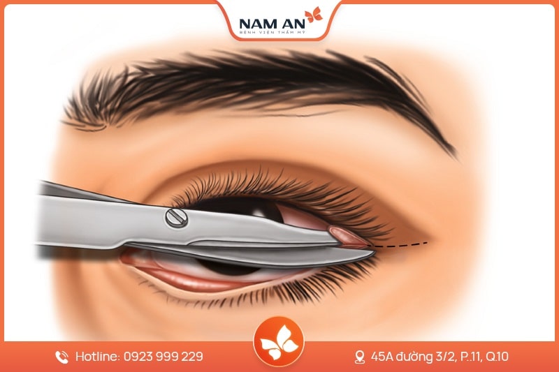 Phẫu Thuật Sửa Lật Mi Mắt An Toàn Tại BVTM Nam An (1)
