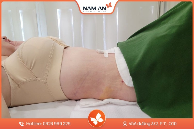 Phẫu Thuật Tạo Hình Thành Bụng Chuẩn Y Khoa Tại Nam An (3)