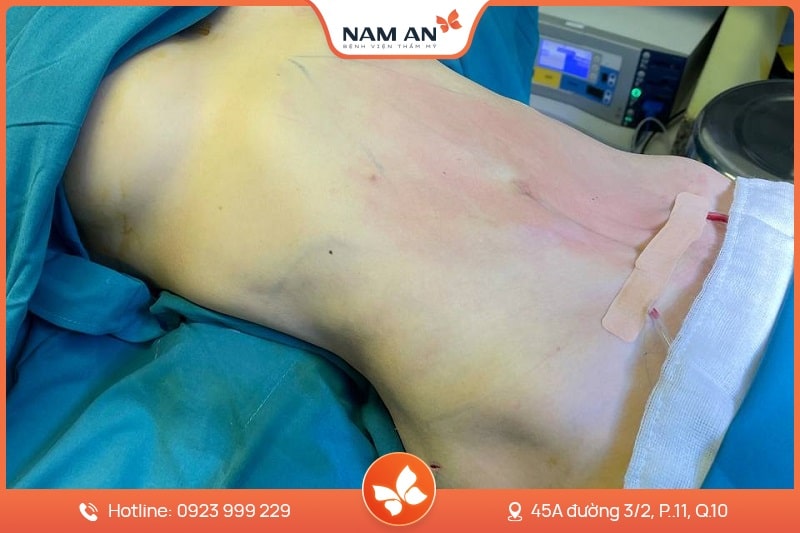 Phẫu Thuật Tạo Hình Thành Bụng Chuẩn Y Khoa Tại Nam An (4)