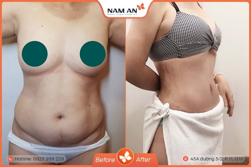 Phẫu Thuật Tạo Hình Thành Bụng Chuẩn Y Khoa Tại Nam An (6)