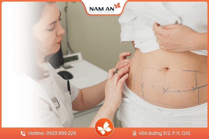 Phẫu Thuật Tạo Hình Thành Bụng Chuẩn Y Khoa Tại Nam An (7)